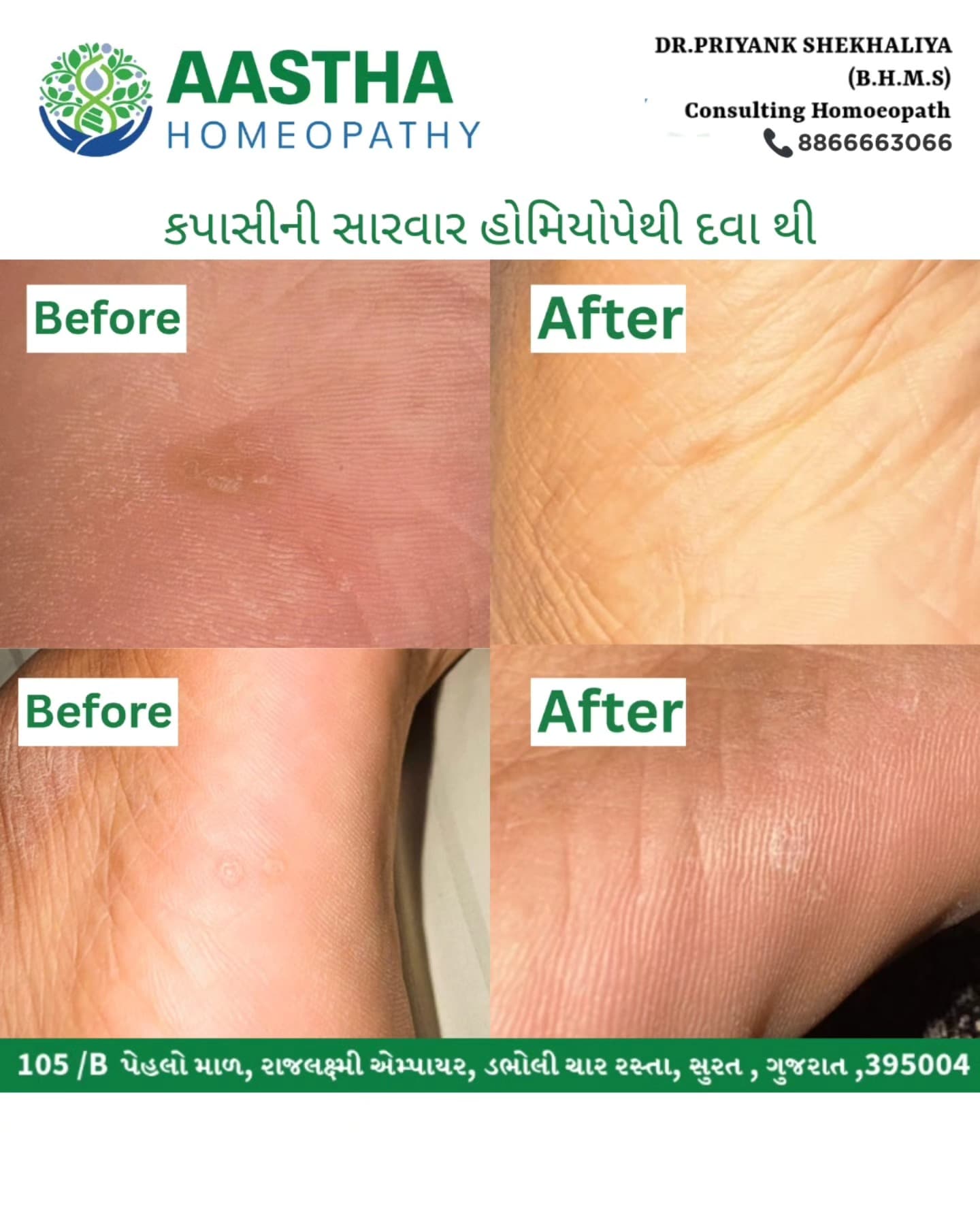 Patient result: Foot corn · 2 months