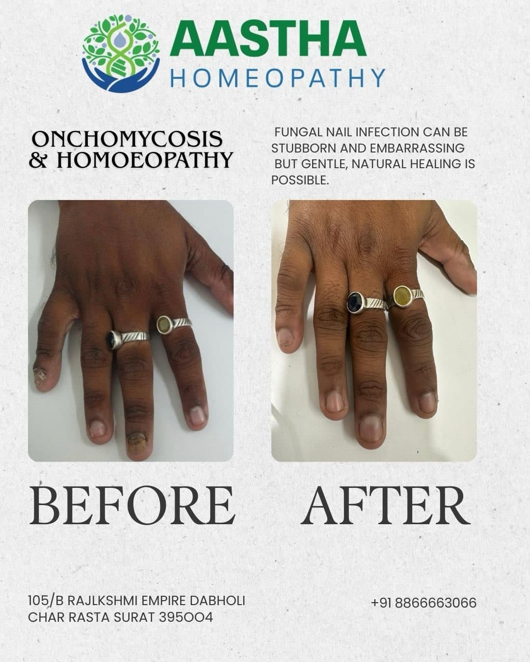 Patient result: Nail infection · 3 months